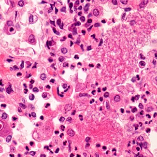 A microscopic image of a lung with pneumocystis pneumonia, the innocuous illness that became fatal in patients with HIV and alerted the CDC to the existence of AIDS.